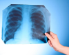 Forsyth County Health Officials Share Latest on Legionnaires’ Disease in Winston-Salem Nursing Home